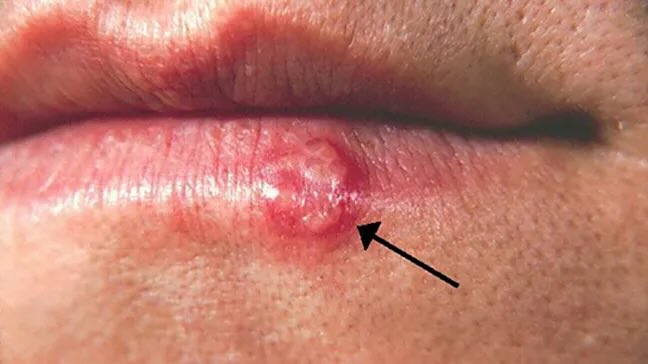 Rid of a Pimple on Your Lip